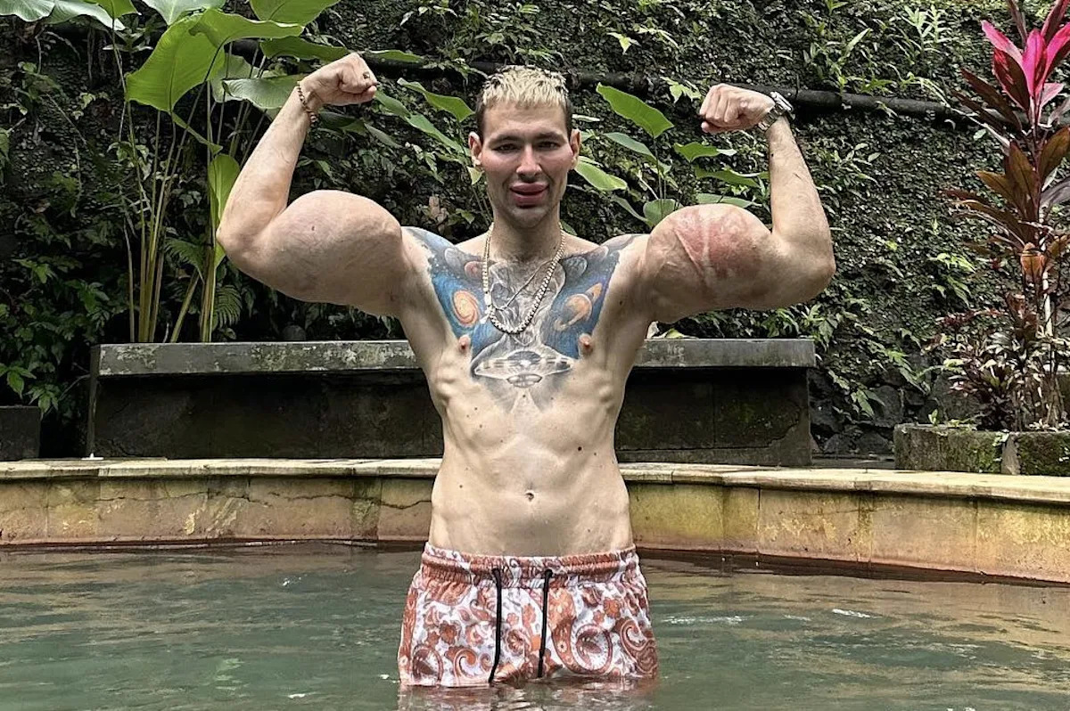 Fenomen həyati təhlükəli nekroz və qol amputasiyası iddialarını təkzib edir