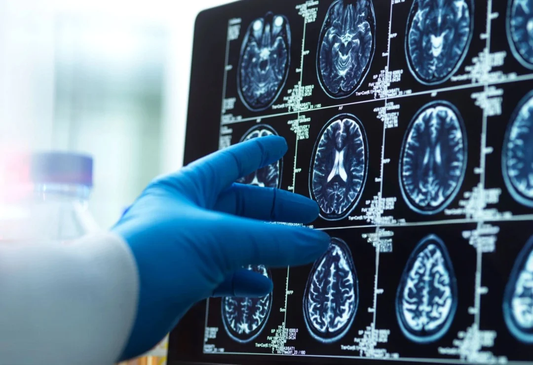 57 yaşında Altsheymer diaqnozu: Erkən müdaxilənin gücü