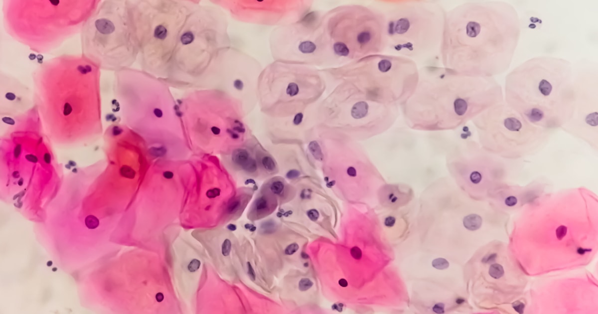 Amerika Xərçəng Cəmiyyəti uşaqlıq boynu xərçəngi skrininqi üçün evdə HPV testini tövsiyə etdi