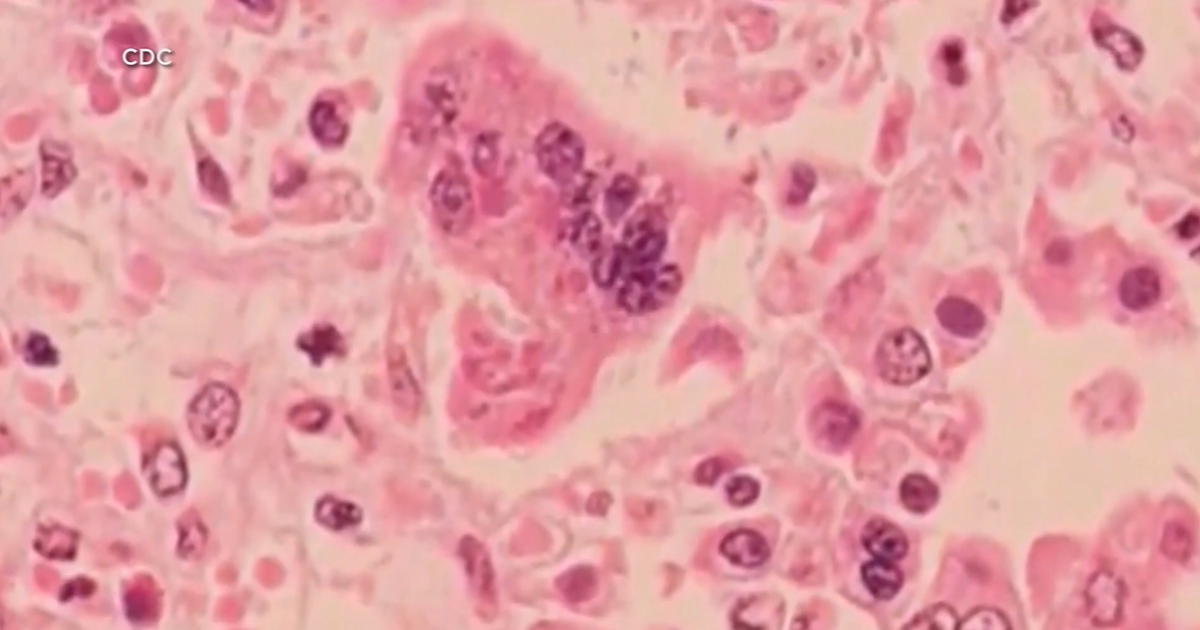 ABŞ universitetində kütləvi qızılca: 57 nəfər yoluxdu