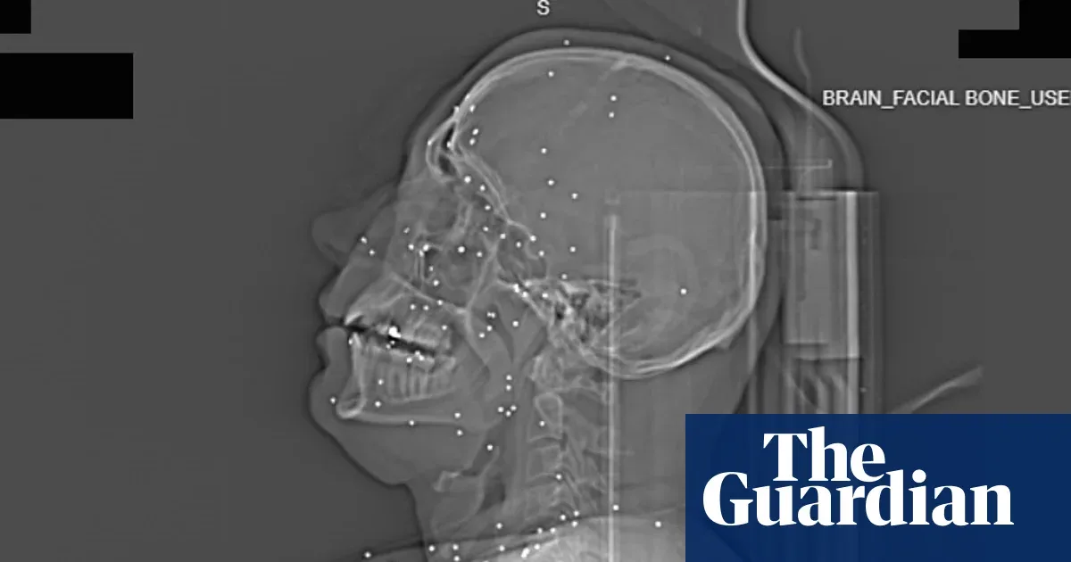 İran etirazları Rentgenlər kritik orqanlara qəsdən zərbələri ifşa edir