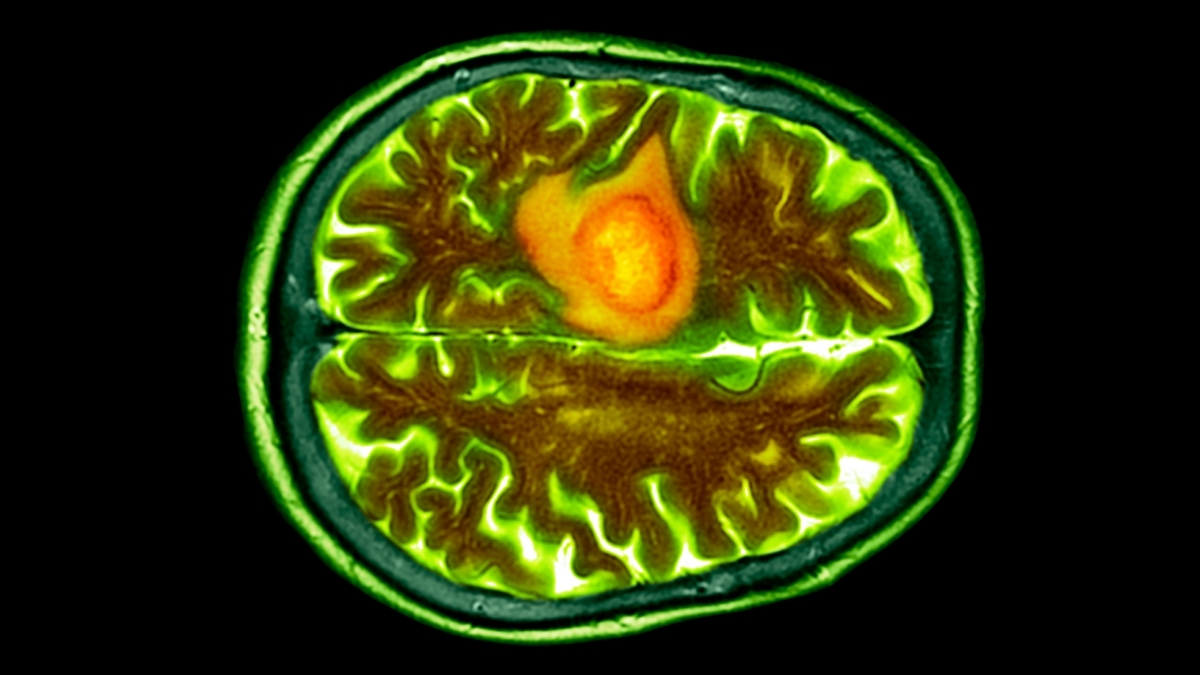 Ölümcül beyin xərçənginə qarşı: Burun damcıları yeni ümid