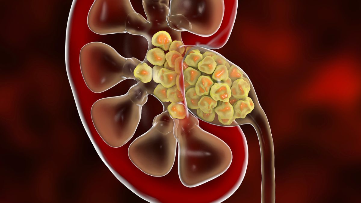 Böyrək daşlarının yaranması haqda bildiklərimizi alt-üst edən kəşf