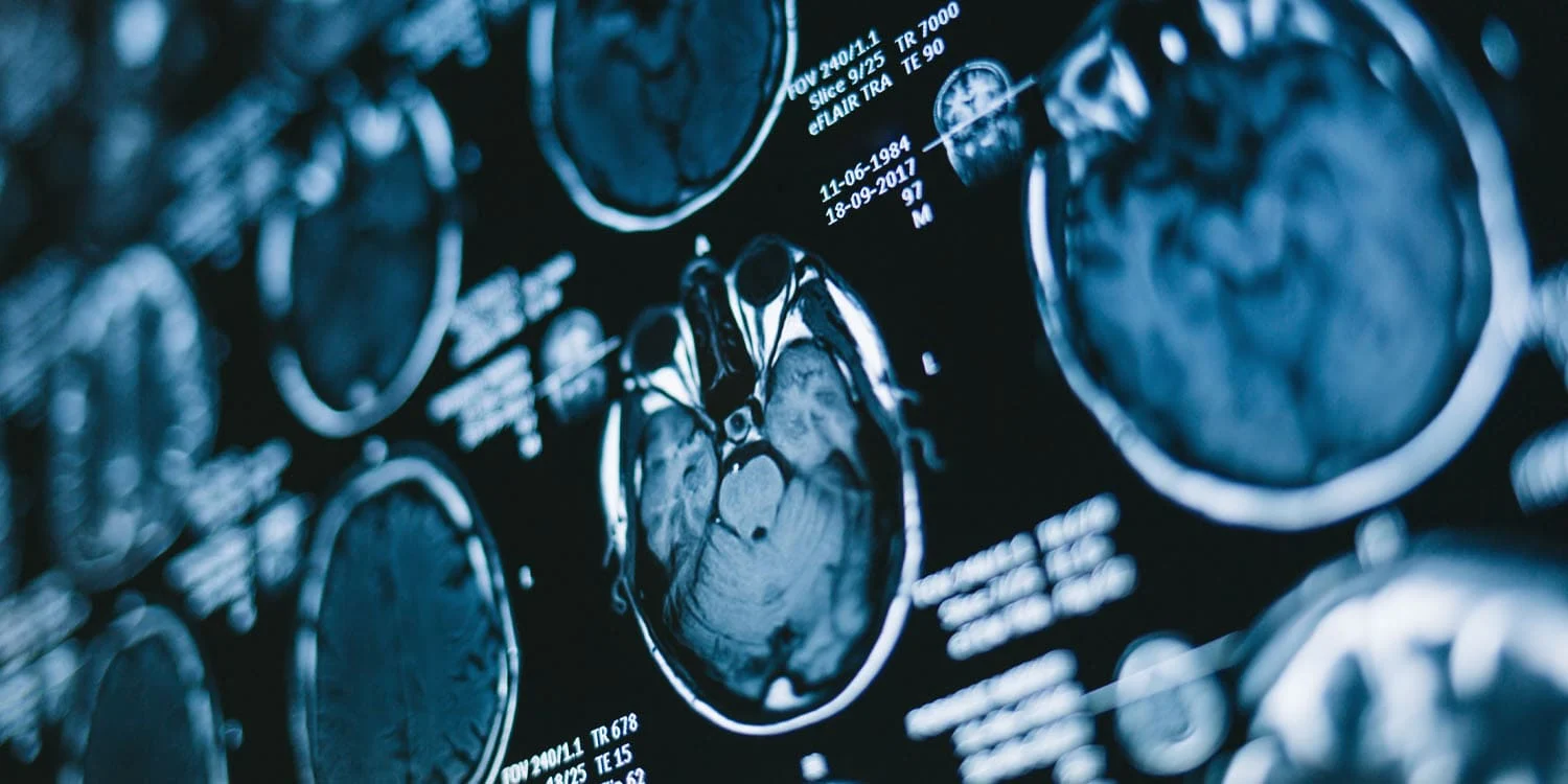 DEHB: Zaman idarəçiliyi çətinliyi müəyyən beyin əlaqələrinə köklənə bilər