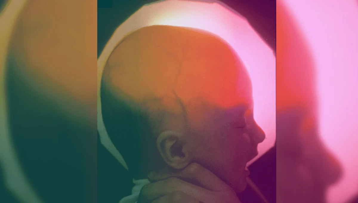 Hidranensefaliyalı qadın 20 yaşını tamamladı