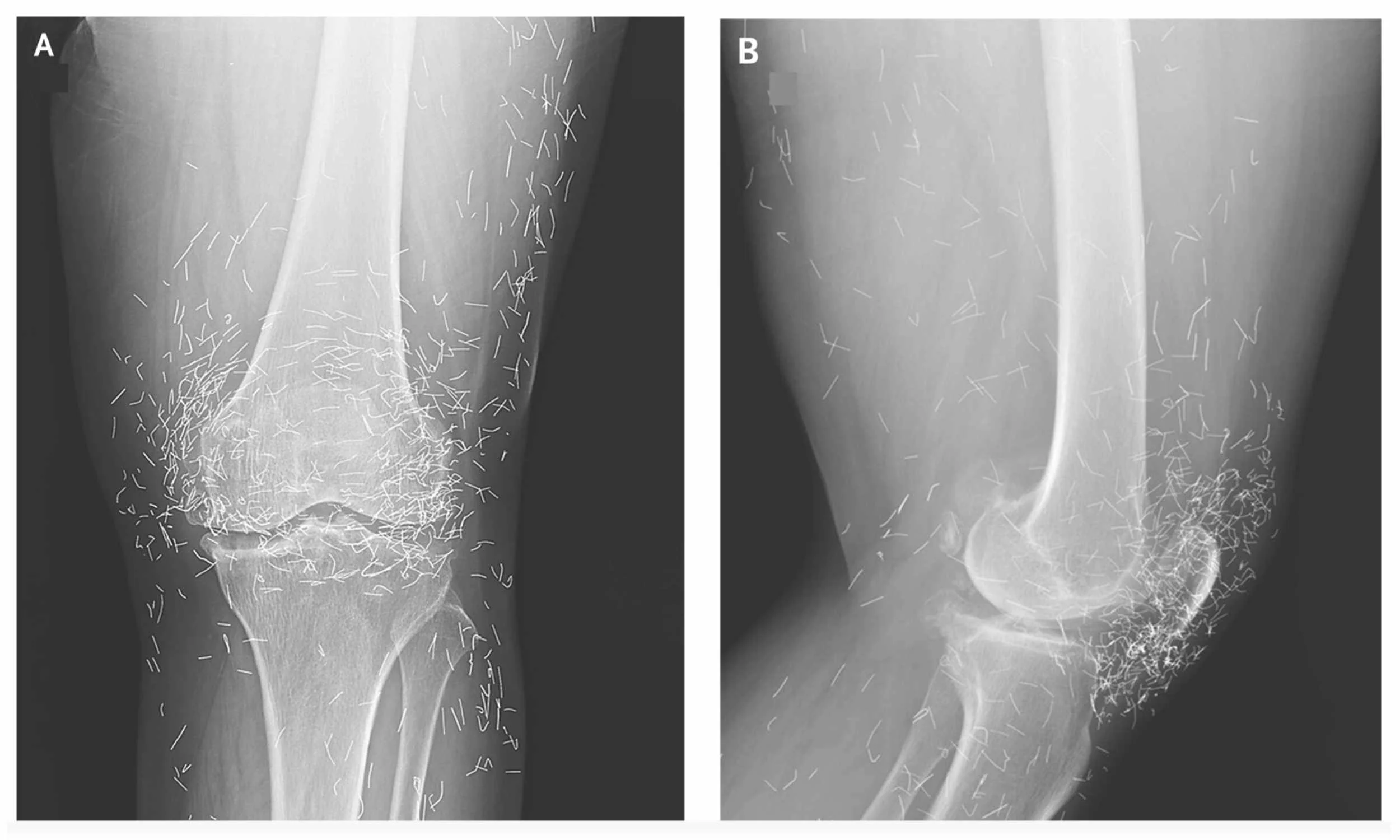 Qadının diz ağrısı: Oynaqlarındakı qızıl saplar səbəb imiş