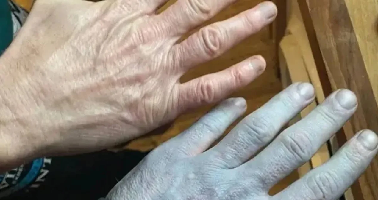 İngiltərədəki mavi dəri sirri: Tikinti fəhləsinin heyrətamiz gerçəyi