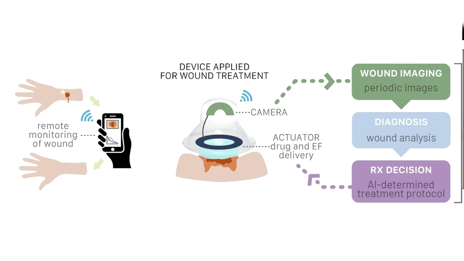 Ağıllı Sarğı Süni İntellektlə Yaraları Sağaldır