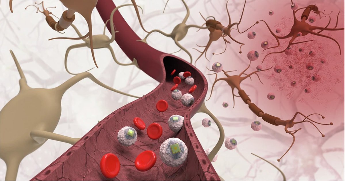 MIT enjekte olunan beyin çipi ixtira etdi